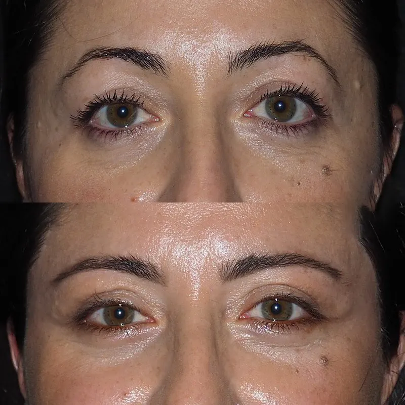 Eye Bag Removal Surgery