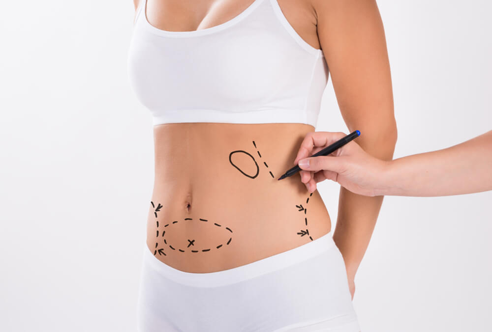 Liposuction