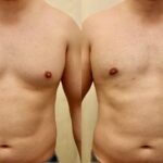 gynecomastia surgery abu dhabi