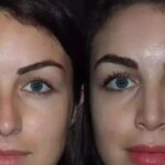 Find Your Nose Twin: Dubai Rhinoplasty Photos