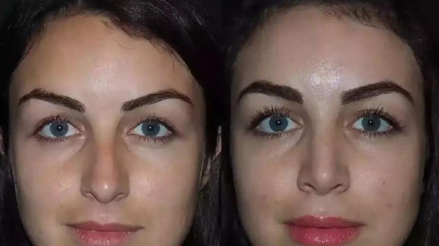 Find Your Nose Twin: Dubai Rhinoplasty Photos