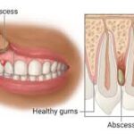 Dental infections are not just uncomfortable but can also cause serious problems if not addressed. Yet, even though dental infections are serious,