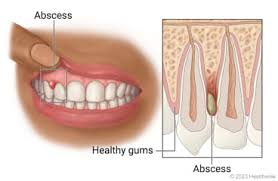 Dental infections are not just uncomfortable but can also cause serious problems if not addressed. Yet, even though dental infections are serious,