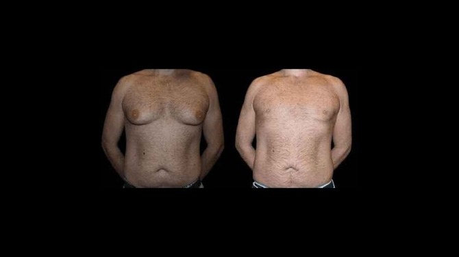 Before and After Male Breast Reduction Results