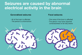 type of seizures