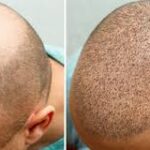 Hair Transplant in Riyadh