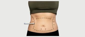 Liposuction Surgery in Dubai