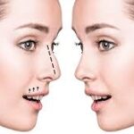 Rhinoplasty in Dubai