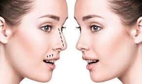 Rhinoplasty in Dubai