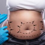 tummy tuck