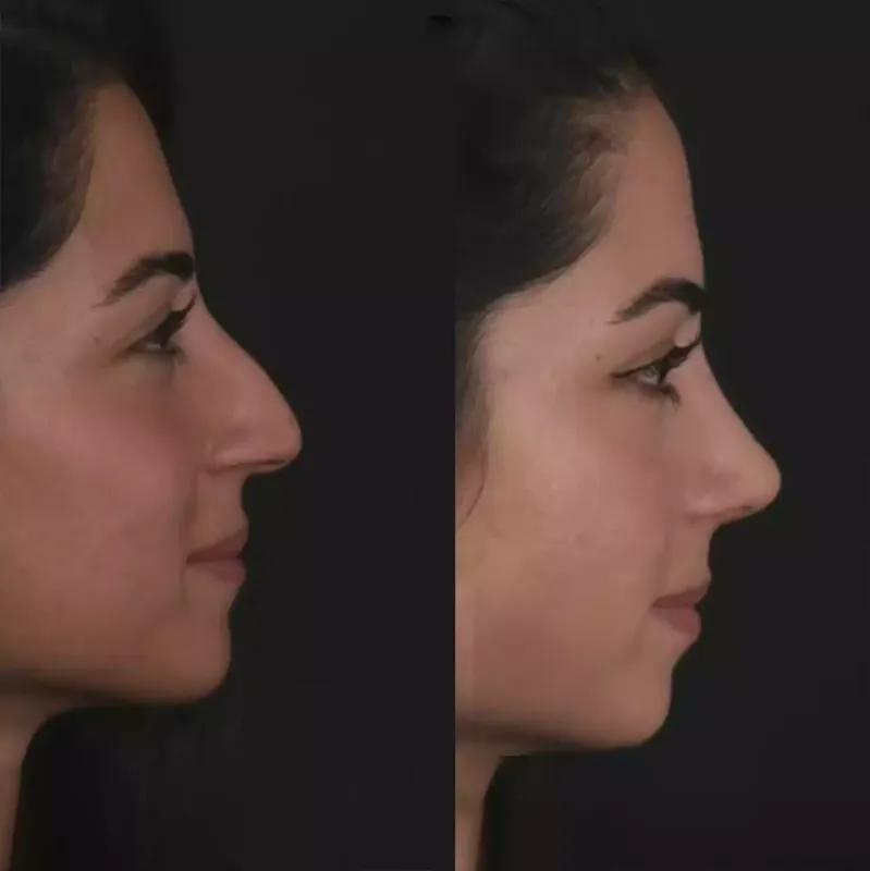 Best Rhinoplasty Surgeons in Dubai: Your Path to Perfection