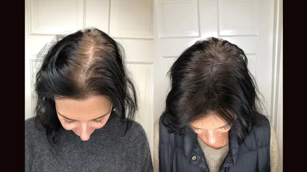 scalp micropigmentation