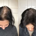 scalp micropigmentation