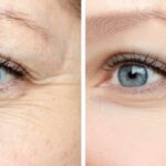 skin fine line treatment Southampton