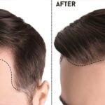 Hair Transplant in Islamabad