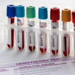 Private Blood Tests Luton Private blood test Luton Blood Test Luton Book blood tests Luton Blood Tests in Luton