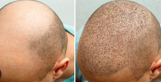 Achieve Natural Hair Restoration: Discover the Best Hair Transplant London