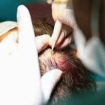 Hair Transplant in Riyadh