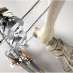 Trauma Fixation Device Market Size And Forecast Report 2024-2032