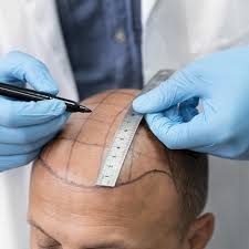 Hair Transplant in Riyadh