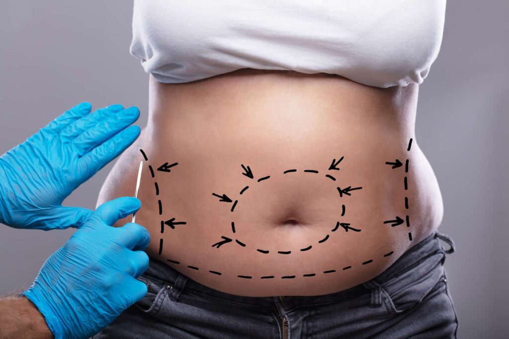 The Role of Family and Social Support in Tummy Tuck Recovery in Dubai