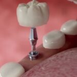 How Long Does a Dental Implant Last