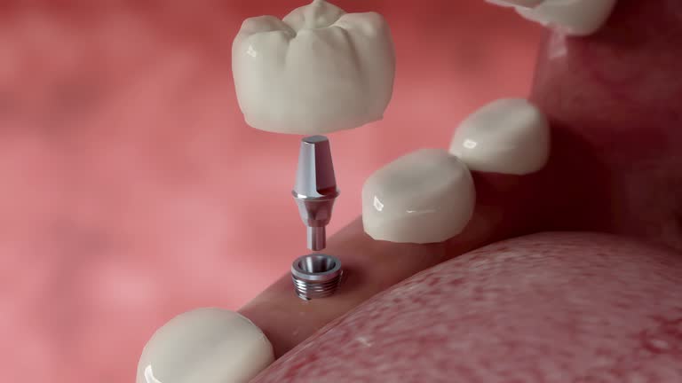 How Long Does a Dental Implant Last