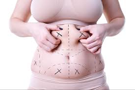 Liposuction Surgery in Riyadh