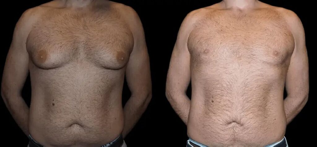 Best Doctors in Dubai: How Dubai’s Best Doctors Achieve Scar-Free Gynecomastia Results