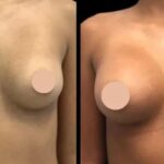 The Best Doctors in Dubai for Breast Augmentation: Transform Your Look with Confidence