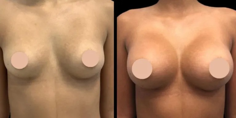 The Best Doctors in Dubai for Breast Augmentation: Transform Your Look with Confidence