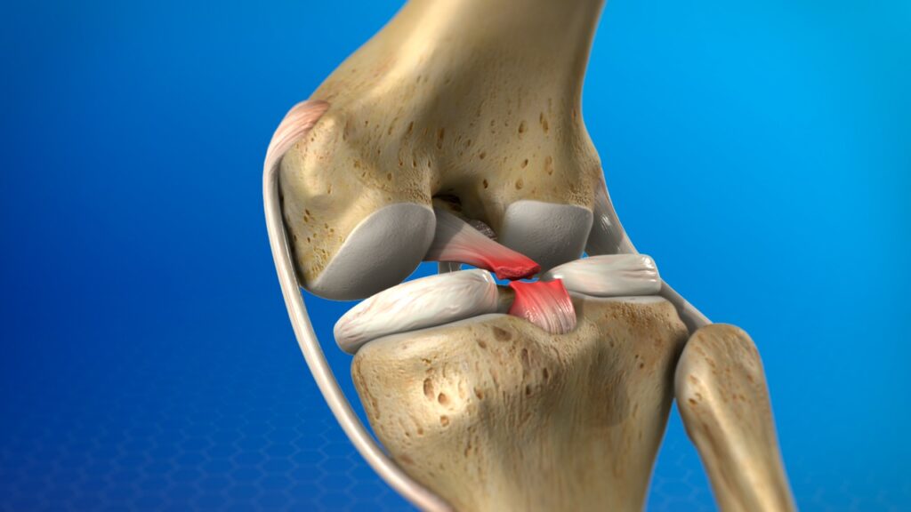 posterior cruciate ligament injury