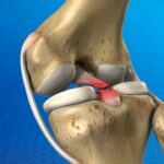 posterior cruciate ligament injury