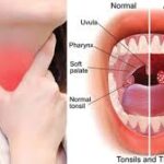 A close-up image of an inflamed throat showing red, swollen tonsils, possibly with white patches, indicating a tonsil infection.