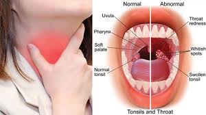 A close-up image of an inflamed throat showing red, swollen tonsils, possibly with white patches, indicating a tonsil infection.